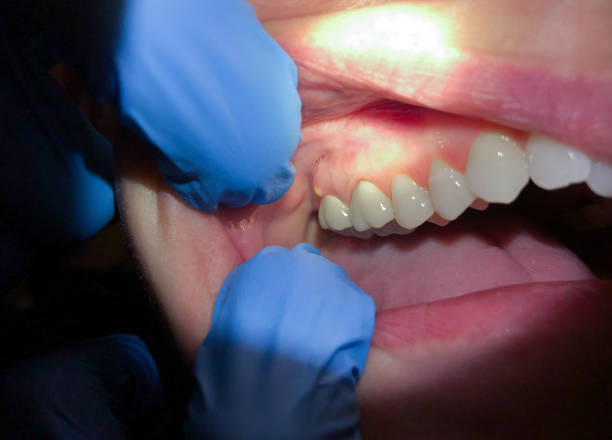 Best Emergency Wisdom Teeth Removal in Mono Vista, CA
